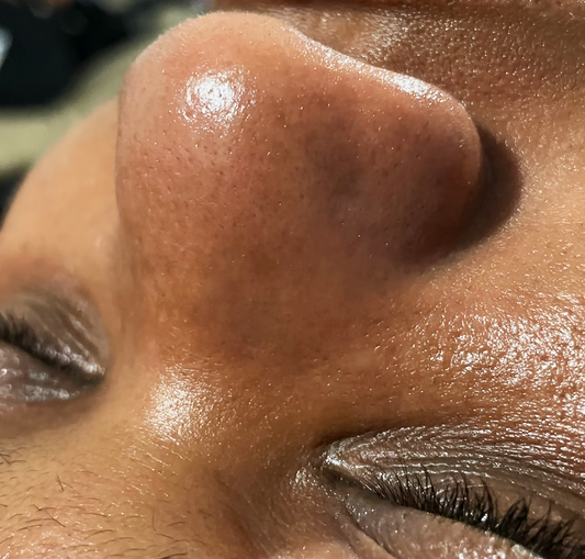 Close-up of a black woman's nose after receiving a facial and getting her pores unclogged